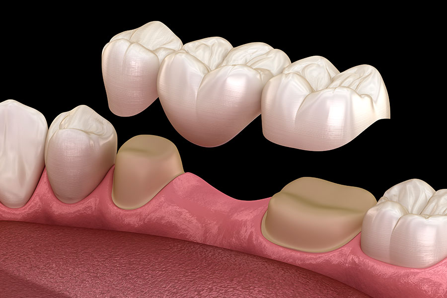 Prótesis dentales fijas