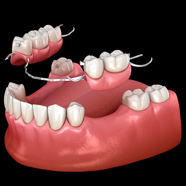 protesis dental removible