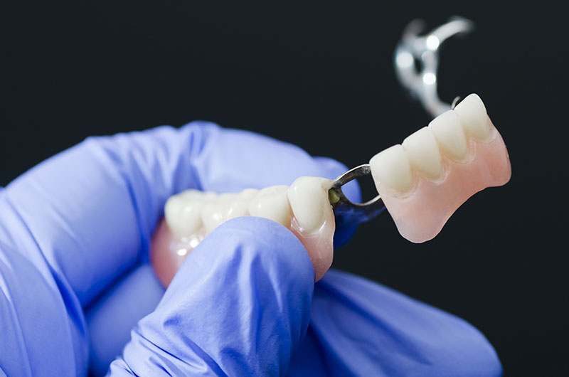 Prótesis Tratamientos Dentales