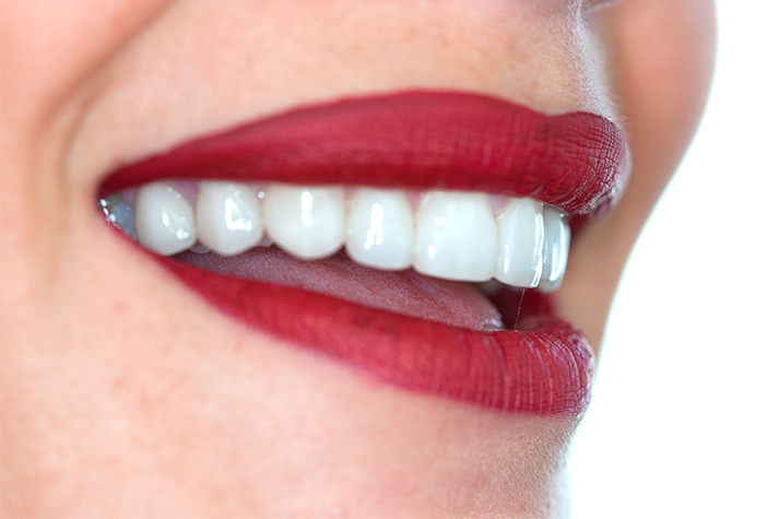 Una mujer vuelve a sonreír sin complejos tras haberse colocado carillas dentales sin tallado.