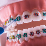 Utilizar el cepillo para ortodoncia adecuado impedirá que la aparición de patologías retrase los resultados del tratamiento.