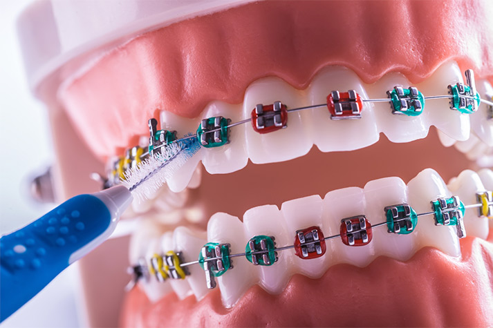 Utilizar el cepillo para ortodoncia adecuado impedirá que la aparición de patologías retrase los resultados del tratamiento.