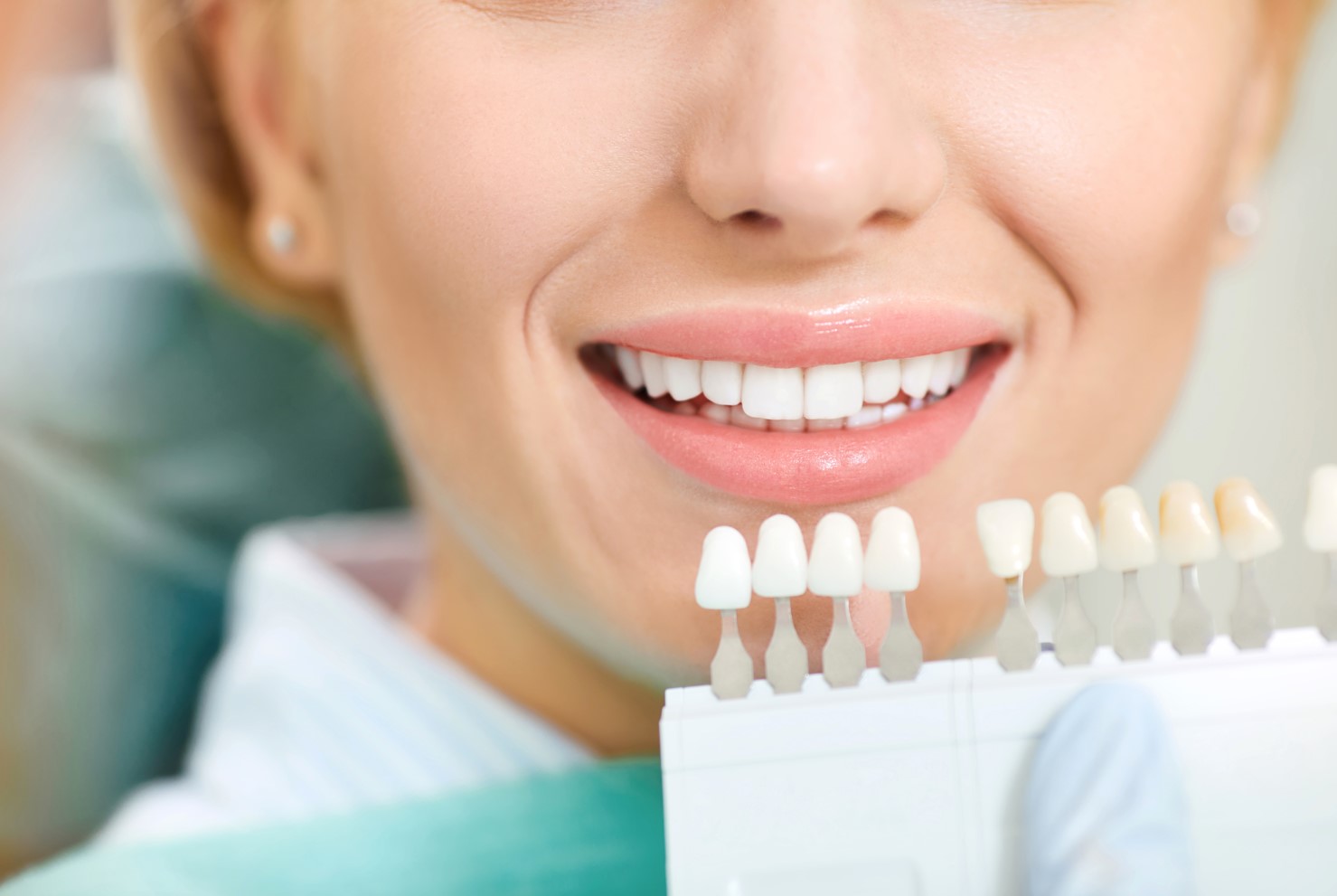 Una mujer sonríe en una prueba de color antes de un blanqueamiento dental en una clínica
