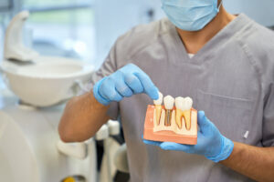 Cuánto duran los implantes dentales