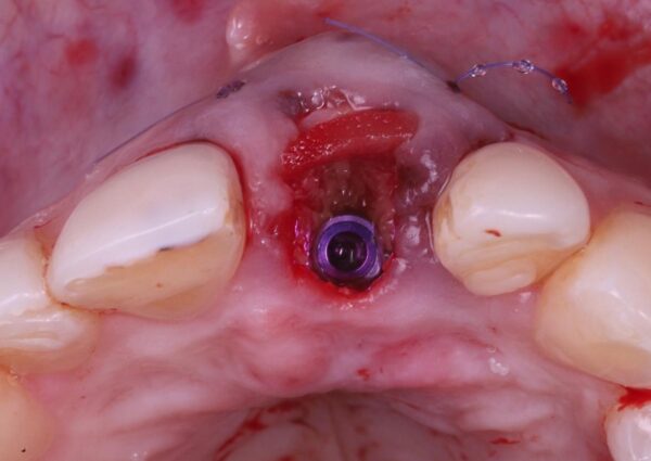 Estética con Implantes en el Sector Anterior - Imagen 4