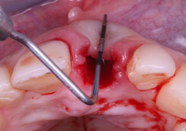 Estética con Implantes en el Sector Anterior - Imagen 2