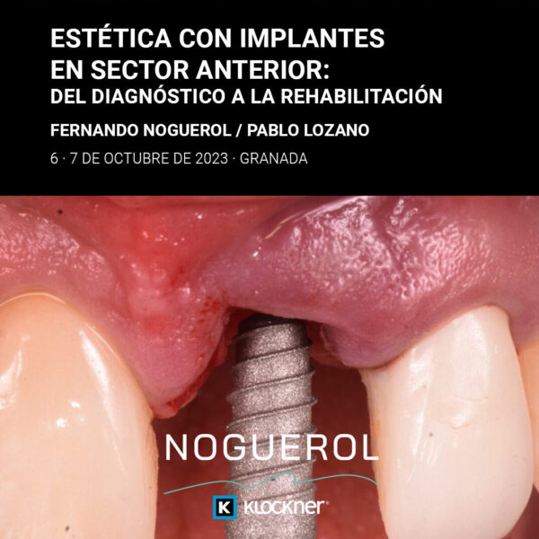 Estética con Implantes en el Sector Anterior