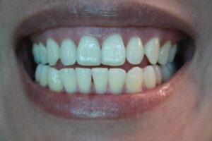 Manchas blancas en los dientes Tratamientos y prevención