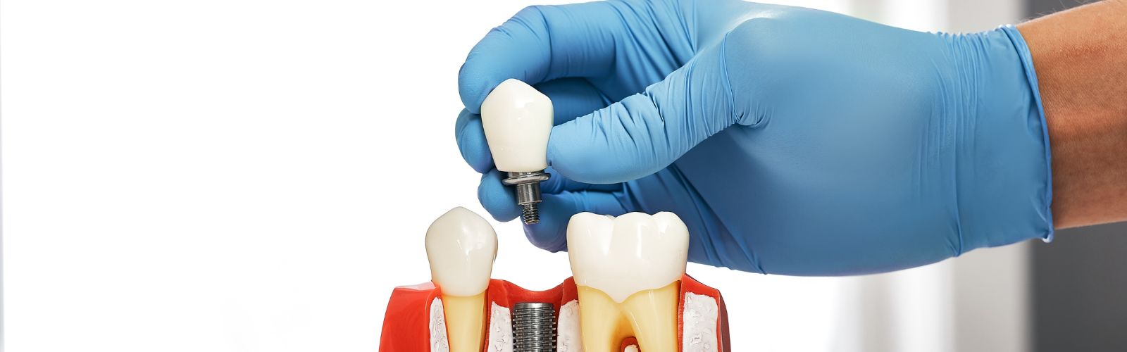Mejor momento para colocarse un implante dental