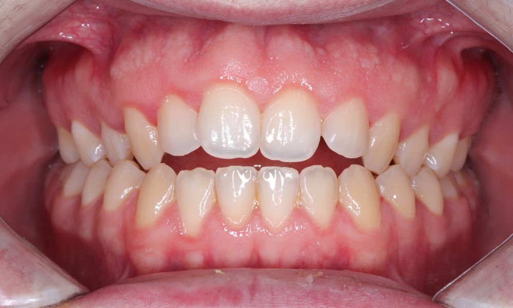 antes invisalign julian Antes de invisalign Julián