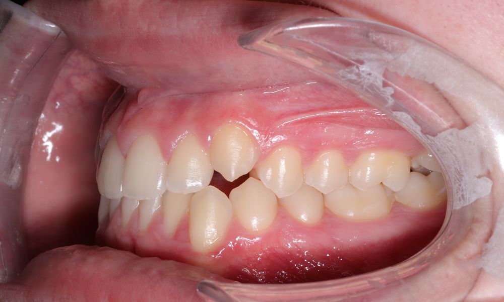 antes invisalign maria Antes de invisalign María