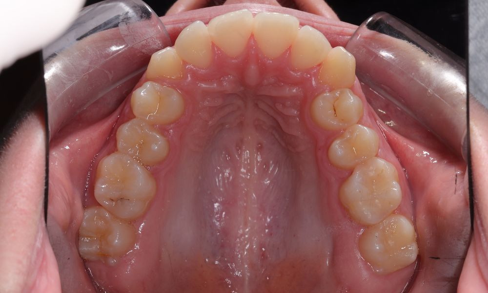 antes maria brackets Antes de brackets María