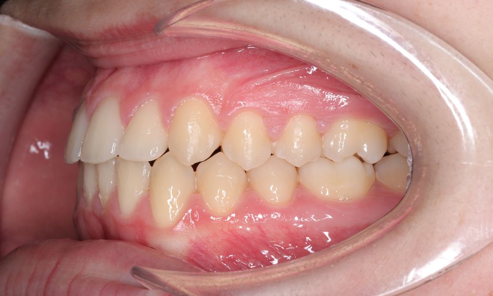 despues invisalign maria Después de invisalign María