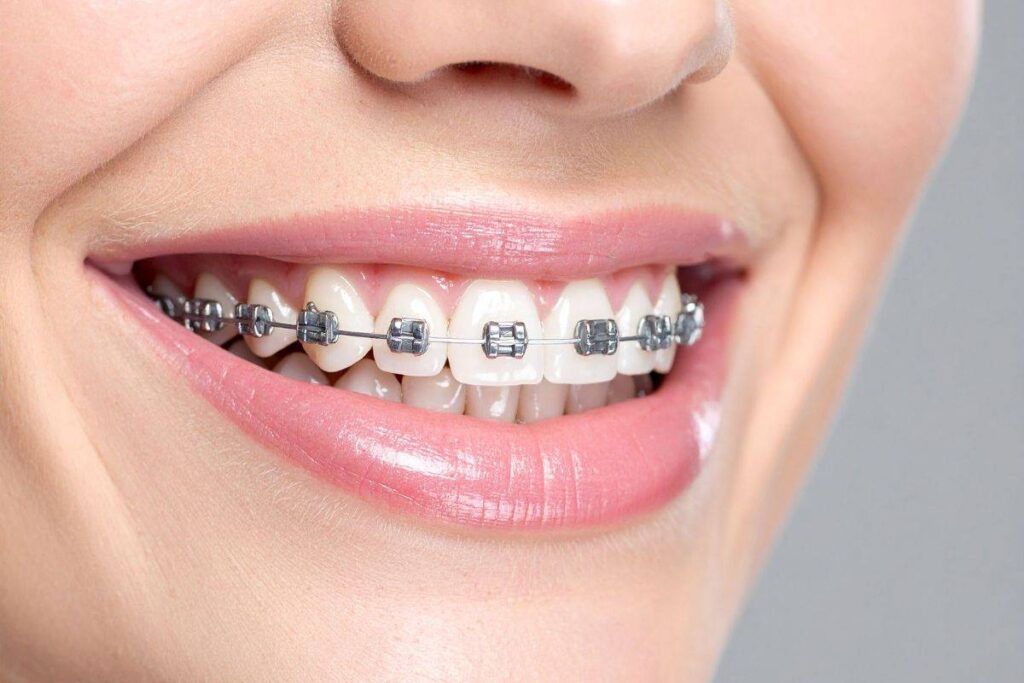 brackets solo arriba