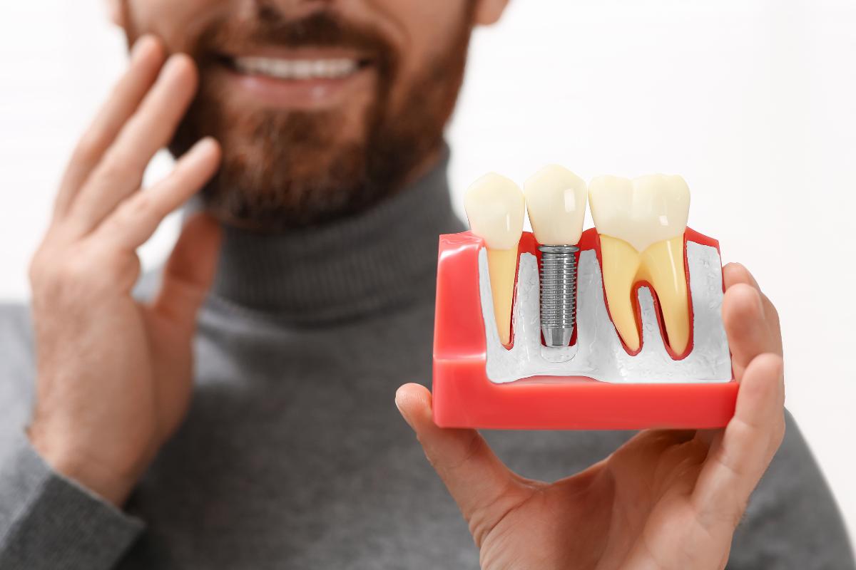 Duele mucho un implante dental La verdad sobre el dolor