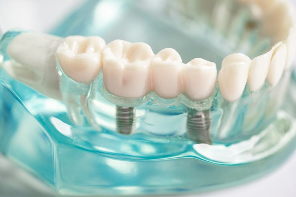 como poner los implantes dentales