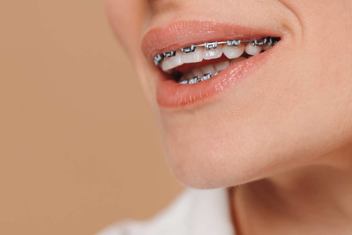 ¿Merece la pena la cirugía ortognática?