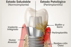Infección en implantes dentales