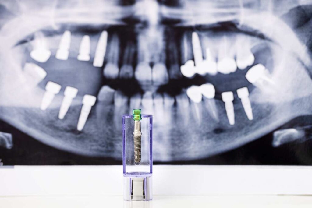 Implantes dentales no hay suficiente hueso