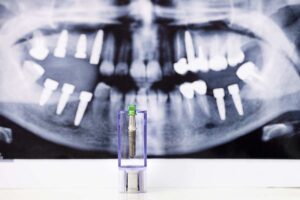 Implantes dentales no hay suficiente hueso
