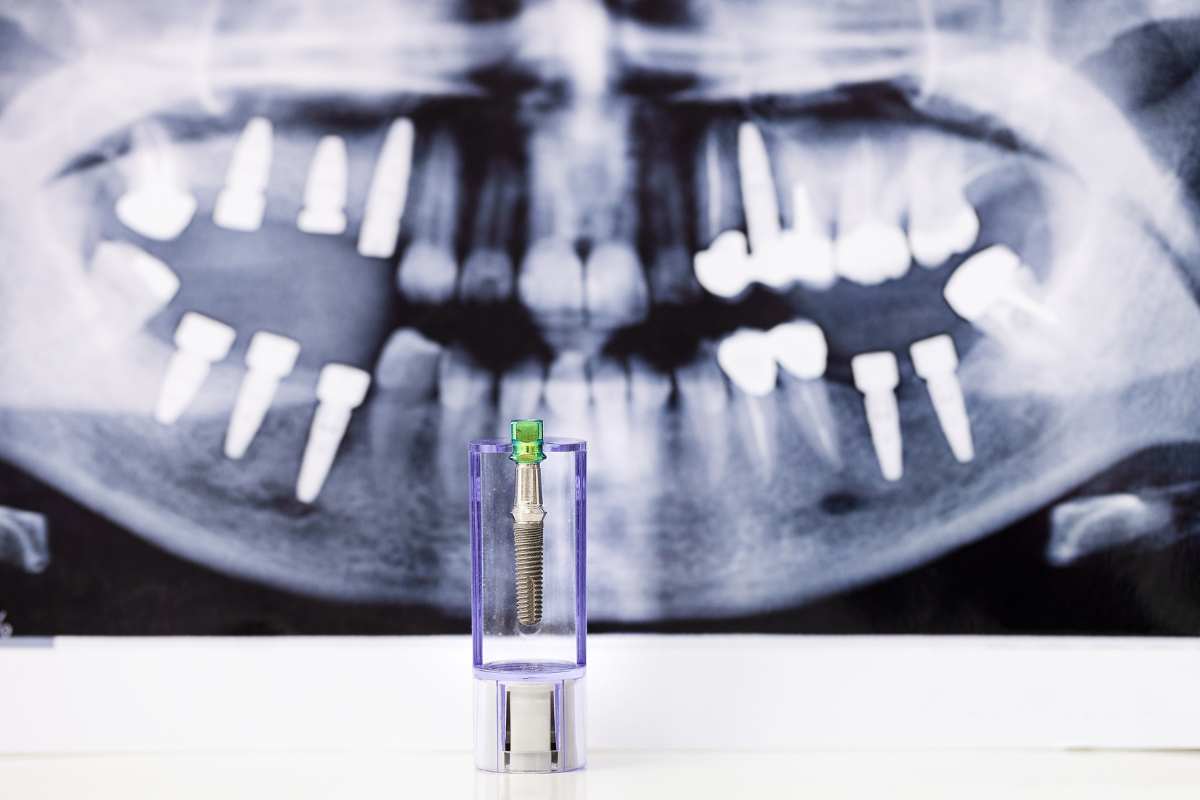 Implantes dentales no hay suficiente hueso