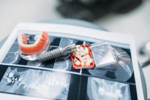 Infección en implantes