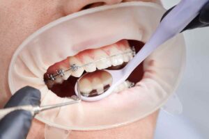 ortodoncia con periodontitis