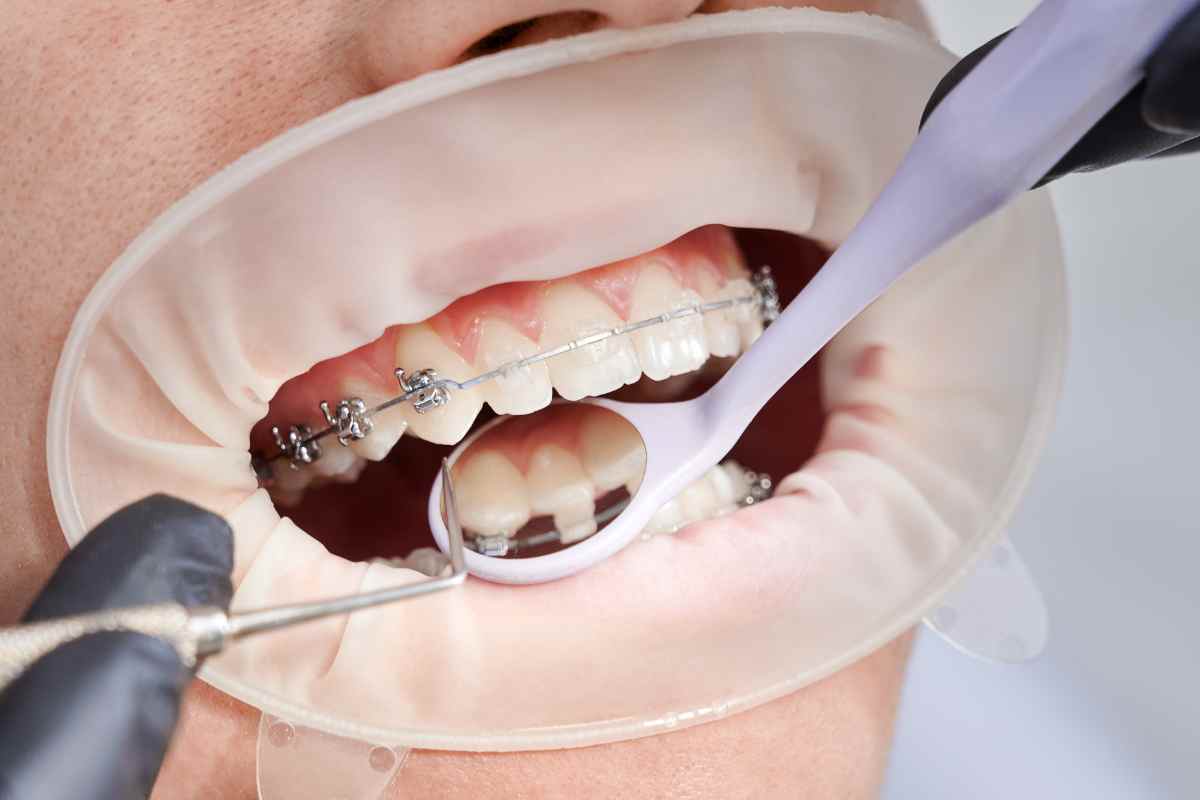 ortodoncia con periodontitis